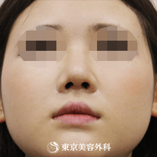 【鼻尖形成、隆鼻術（プロテーゼ）｜si4833】の症例写真 術後2ヵ月【6枚目】