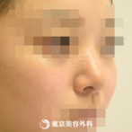 鼻中隔延長（軟骨移植）、隆鼻術（オーダーメードプロテーゼ）、小鼻縮小(内側）、鼻尖形成、鼻骨骨切り｜gz6306_】団子鼻をシュッとしたキレイな鼻にの症例