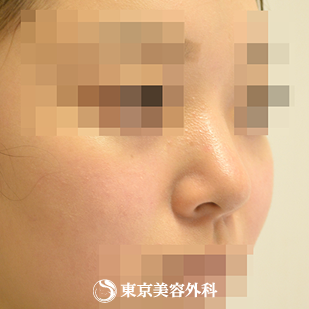 【鼻中隔延長（軟骨移植）、隆鼻術（オーダーメードプロテーゼ）、小鼻縮小(内側）、鼻尖形成、鼻骨骨切り｜gz6306_】の症例写真 before【1枚目】