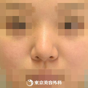 【鼻中隔延長（軟骨移植）、隆鼻術（オーダーメードプロテーゼ）、小鼻縮小(内側）、鼻尖形成、鼻骨骨切り｜gz6306_】の症例写真 before【3枚目】