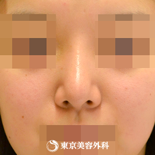 【鼻中隔延長（軟骨移植）、隆鼻術（オーダーメードプロテーゼ）、小鼻縮小(内側）、鼻尖形成、鼻骨骨切り｜gz6306_】の症例写真 after【4枚目】