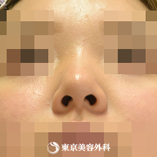 【鼻中隔延長（軟骨移植）、隆鼻術（オーダーメードプロテーゼ）、小鼻縮小(内側）、鼻尖形成、鼻骨骨切り｜gz6306_】の症例写真 before【7枚目】