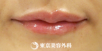 【口唇ヒアルロン酸注入｜um2859】プルっとふっくら魅力的な唇にの症例