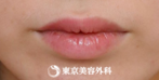 【口唇ヒアルロン酸注入｜as270】愛らしい唇のシルエットにの症例