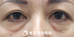 【目の下脂肪取り、目の下ヒアルロン酸｜fy7601】目の下がスッキリの症例