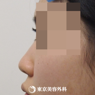 【隆鼻術（オーダーメードプロテーゼ）、小鼻縮小(外側切開）、ケーブル法｜ak3748_】の症例写真 before【3枚目】