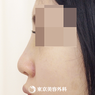 【隆鼻術（オーダーメードプロテーゼ）、小鼻縮小(外側切開）、ケーブル法｜ak3748_】の症例写真 after【4枚目】