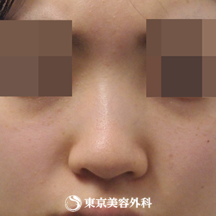 【隆鼻術（オーダーメードプロテーゼ）、小鼻縮小(外側切開）、ケーブル法｜ak3748_】の症例写真 before【5枚目】