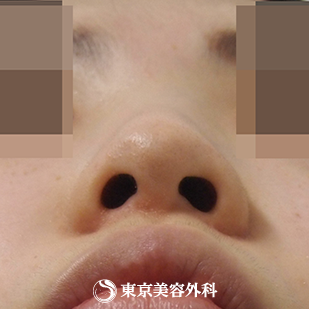 【隆鼻術（オーダーメードプロテーゼ）、小鼻縮小(外側切開）、ケーブル法｜ak3748_】の症例写真 before【7枚目】
