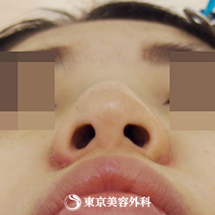 【隆鼻術（オーダーメードプロテーゼ）、小鼻縮小(外側切開）、ケーブル法｜ak3748_】の症例写真 after【8枚目】