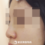 【隆鼻術（オーダーメードプロテーゼ）、小鼻縮小(外側切開）、ケーブル法｜ak3748_】の症例