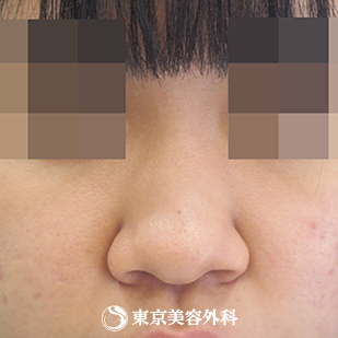 【鼻プロテ、鼻中隔延長、鼻尖形成、鼻骨切｜si7219】の症例写真 before【1枚目】