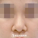 【鼻プロテ、鼻中隔延長、鼻尖形成、鼻骨切｜si7219】の症例