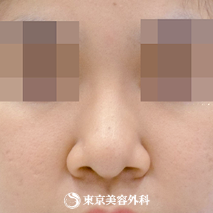 【鼻プロテ、鼻中隔延長、鼻尖形成、鼻骨切｜si7219】の症例写真 after【2枚目】