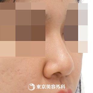 【鼻プロテ、鼻中隔延長、鼻尖形成、鼻骨切｜si7219】の症例写真 after【4枚目】