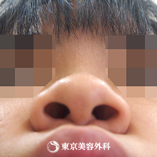 【鼻プロテ、鼻中隔延長、鼻尖形成、鼻骨切｜si7219】の症例写真 before【5枚目】