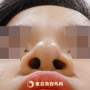 【鼻プロテ、鼻中隔延長、鼻尖形成、鼻骨切｜si7219】の症例写真 after【6枚目】
