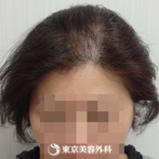 【オリジナル発毛薬・メソセラピー｜ow7758】女性発毛 年齢：40代の症例
