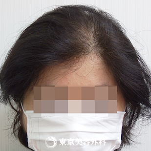 【オリジナル発毛薬・メソセラピー｜ow7758】の症例写真 6ヶ月後【2枚目】