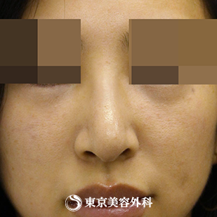 【鼻中隔延長、鷲鼻削り（ハンプ削り）｜si594】の症例写真 術後1ヵ月【6枚目】