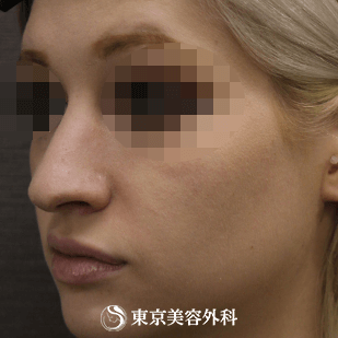 【鼻尖形成、ハンプ削り）｜si3024】の症例写真 before【1枚目】