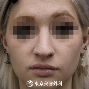 【鼻尖形成、ハンプ削り）｜si3024】の症例写真 before【5枚目】