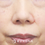 【ほくろ除去（切開）｜AR5849】大きなホクロも切除でスッキリ小鼻にの症例