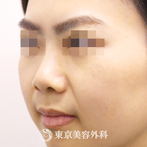 【鼻中隔延長（軟骨移植）、隆鼻術（オーダーメードプロテーゼ）｜si9495】の症例