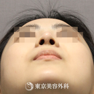 【鼻中隔延長（軟骨移植）、隆鼻術（オーダーメードプロテーゼ）｜si9495】の症例写真 after【8枚目】