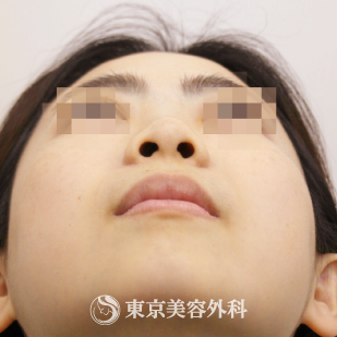 【鼻中隔延長（軟骨移植）、隆鼻術（オーダーメードプロテーゼ）｜si9495】の症例写真 before【7枚目】