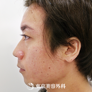 【鼻・頬・顎ヒアルロン酸｜si1777】の症例写真 before【3枚目】