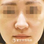【鼻尖形成 鼻中隔延長 耳介軟骨移植 小鼻縮小｜gq10188】の症例