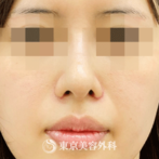 【鼻中隔延長・鼻尖形成・ｵｰﾀﾞｰﾌﾟﾛﾃ・小鼻縮小｜gq13661】の症例
