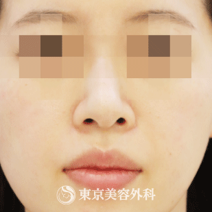 【鼻中隔延長・鼻尖形成・ｵｰﾀﾞｰﾌﾟﾛﾃ・小鼻縮小｜gq13661】の症例写真 before【1枚目】