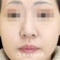 小鼻が大きくなる原因は 対策をして小さくしていこう 美容整形は東京美容外科 小鼻が大きくなる原因は 対策をして小さくしていこう 美容整形は東京美容外科