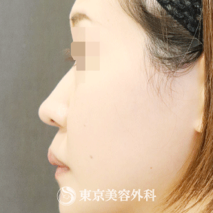 【鼻オーダーメイドプロテーゼ｜gq14058】の症例写真 before【5枚目】