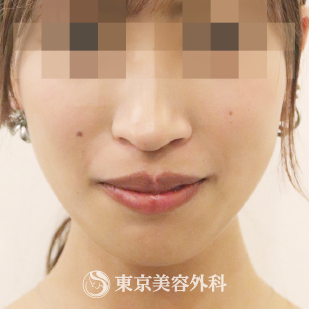 【顎矯正手術｜ta3103】の症例写真 before【1枚目】