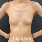 【豊胸手術（シリコンバック）｜si14032】の症例