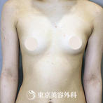 【豊胸手術（シリコンバック）｜si15218】の症例