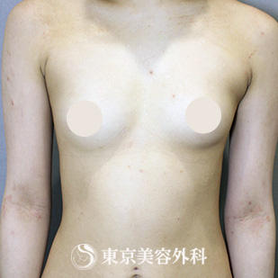【豊胸手術（シリコンバック）｜si15218】の症例写真 before【1枚目】