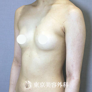 【豊胸手術（シリコンバック）｜si15218】の症例写真 before【3枚目】