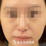 【鼻中隔延長、鼻尖形成、隆鼻術、他院修正｜si15340】の症例