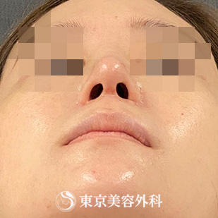 【鼻中隔延長、鼻尖形成、隆鼻術、他院修正｜si15340】の症例写真 after【6枚目】