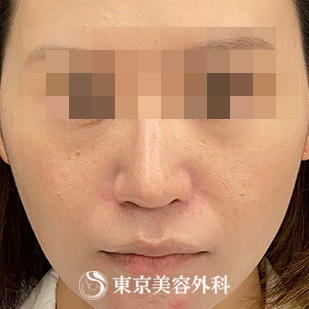 【鼻中隔延長、鼻尖形成、隆鼻術、他院修正｜si15340】の症例写真 before【1枚目】