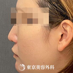 【鼻中隔延長、鼻尖形成、隆鼻術、他院修正｜si15340】の症例写真 before【3枚目】