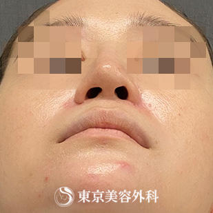 【鼻中隔延長、鼻尖形成、隆鼻術、他院修正｜si15340】の症例写真 before【5枚目】