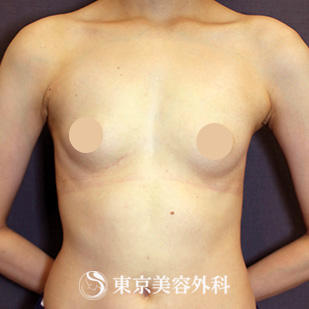 【豊胸手術（シリコンバック）｜si15384】の症例写真 before【1枚目】