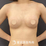 【豊胸手術（シリコンバック）｜si15475】の症例