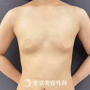 【豊胸手術（シリコンバック）｜si15475】の症例写真 before【1枚目】