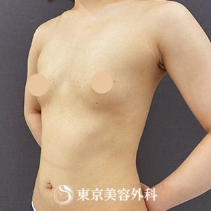 【豊胸手術（シリコンバック）｜si15475】の症例写真 before【3枚目】